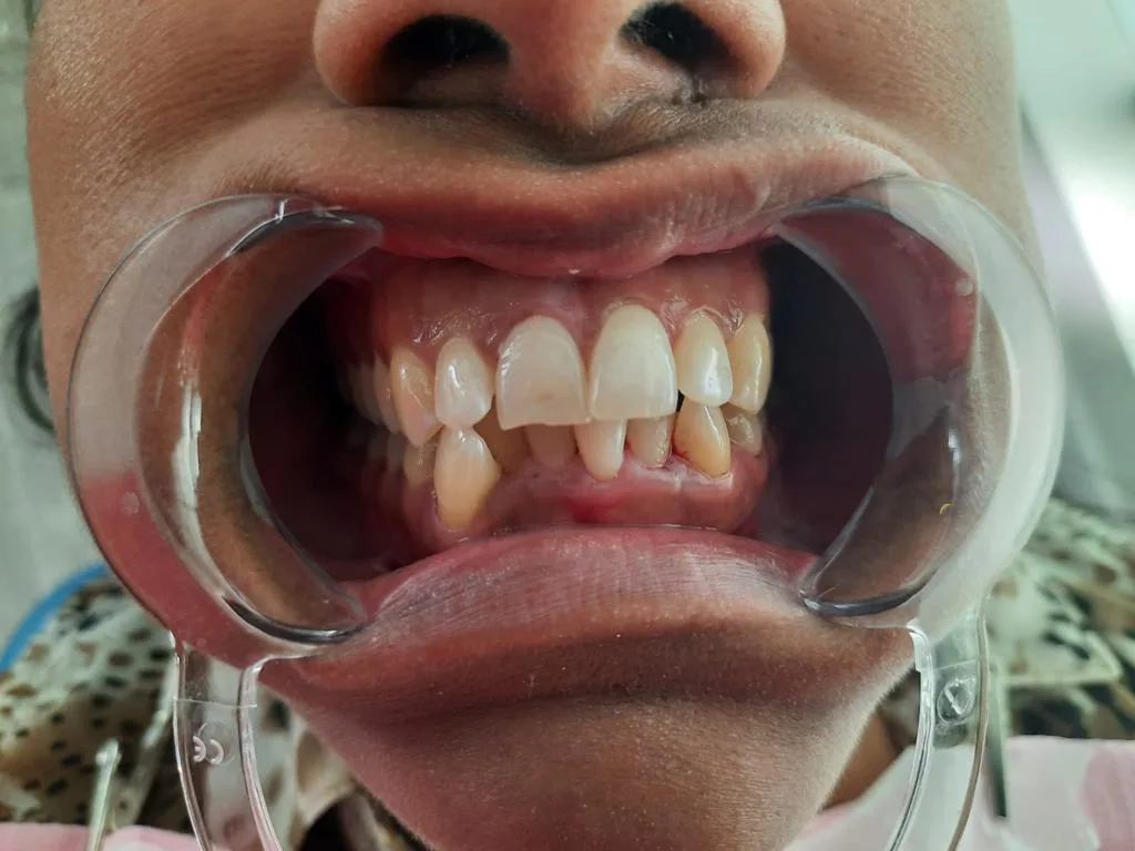 Antes tratamiento dental Smile Care