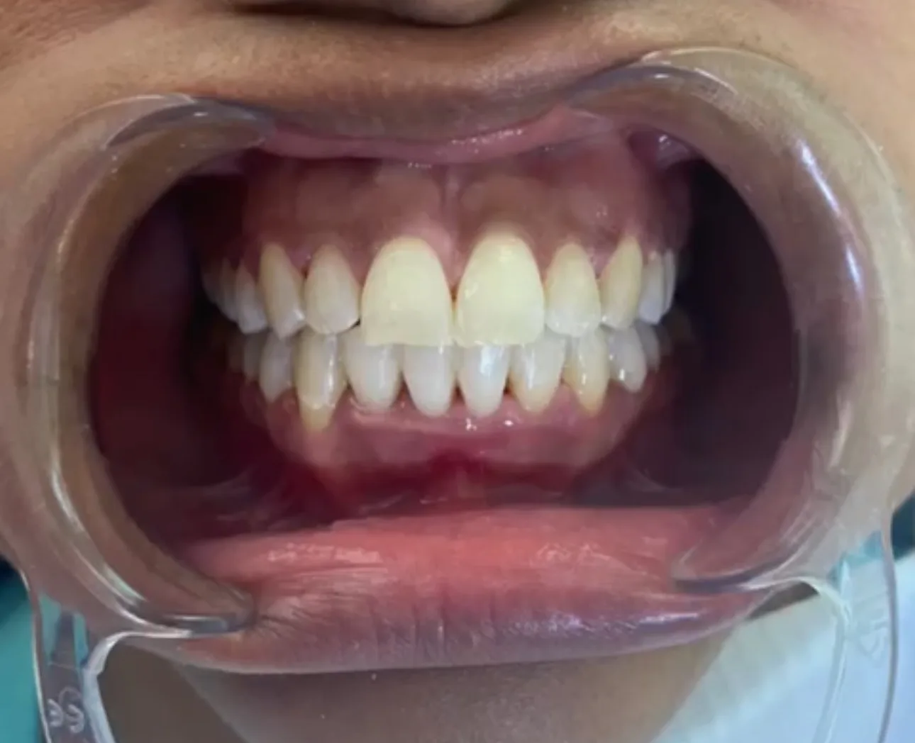 Después tratamiento dental Smile Care
