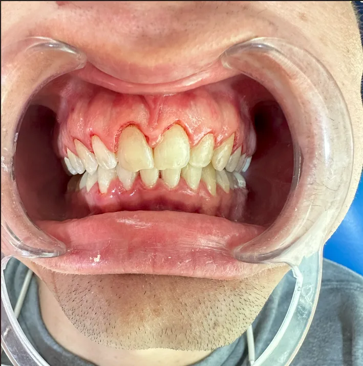 Después ortodoncia y corte de encías Smile Care