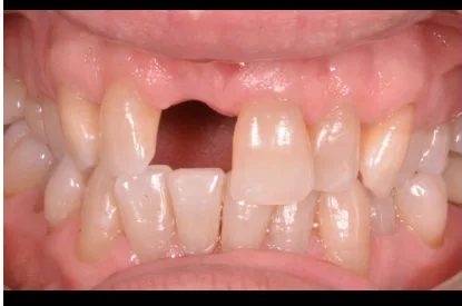 Antes implante dental Smile Care
