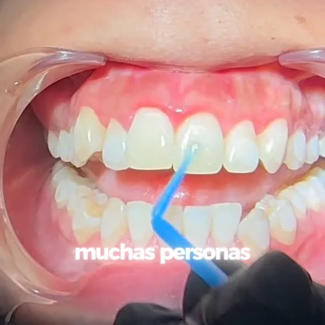 Tratamiento de ortodoncia con brackets en Smile Care Providencia